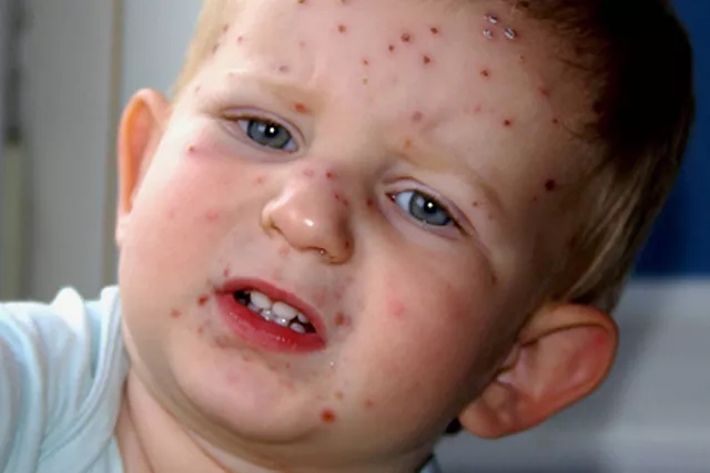 Do children vaccinate against chickenpox?